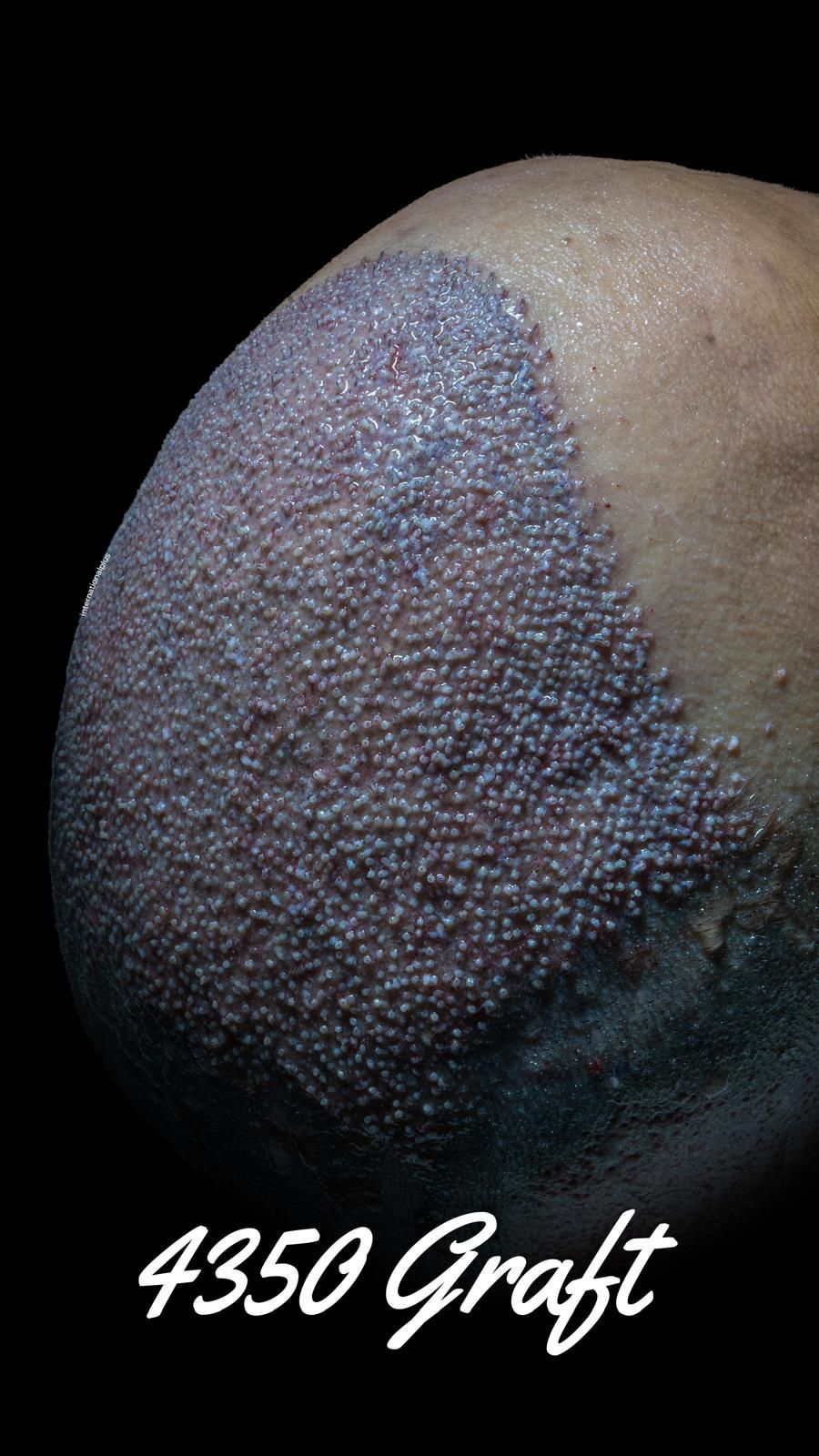 hair transplant clinic near me